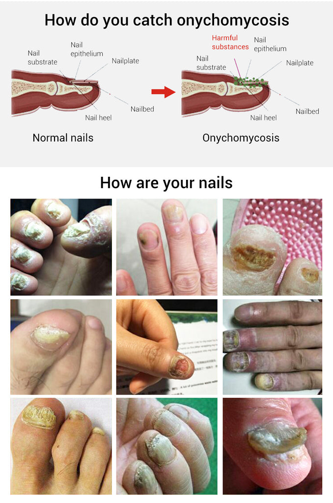 LANBENA Nail Care Gel Fungal Nail Treatment Remove Onychomycosis Nail Care-Skin care-1stAvenue