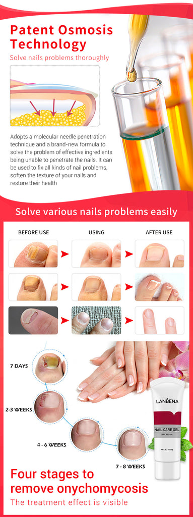 LANBENA Nail Care Gel Fungal Nail Treatment Remove Onychomycosis Nail Care-Skin care-1stAvenue